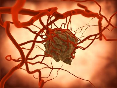 Tumor - Ursachen, Symptome & Behandlung | MedLexi.de - Tumor Met Haren En Tanden
