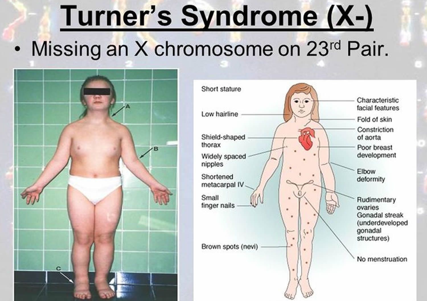 Turner syndrome - MEDizzy - Syndroom Van Turner Uiterlijke Kenmerken