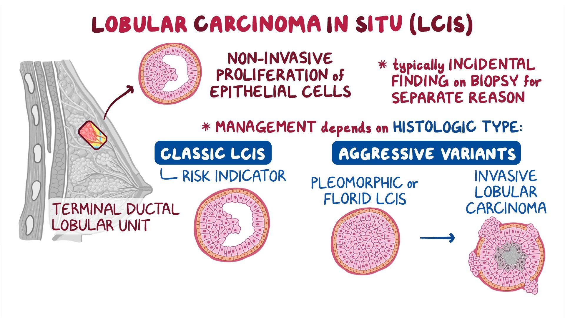 Types Of Breast Cancer: Common Types, Other Types, Stats, 46% OFF - Invasief Lobulair Carcinoom Graad 2