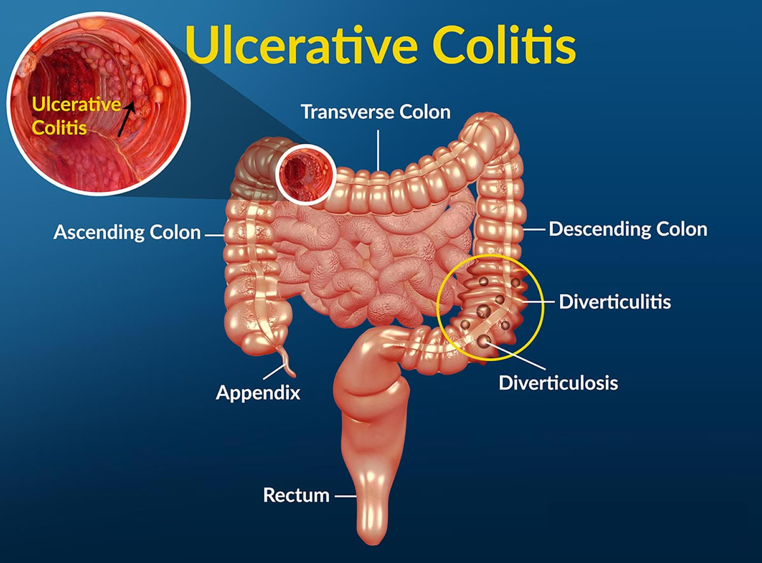 Colitis Ulcerosa En Crohn Verschil