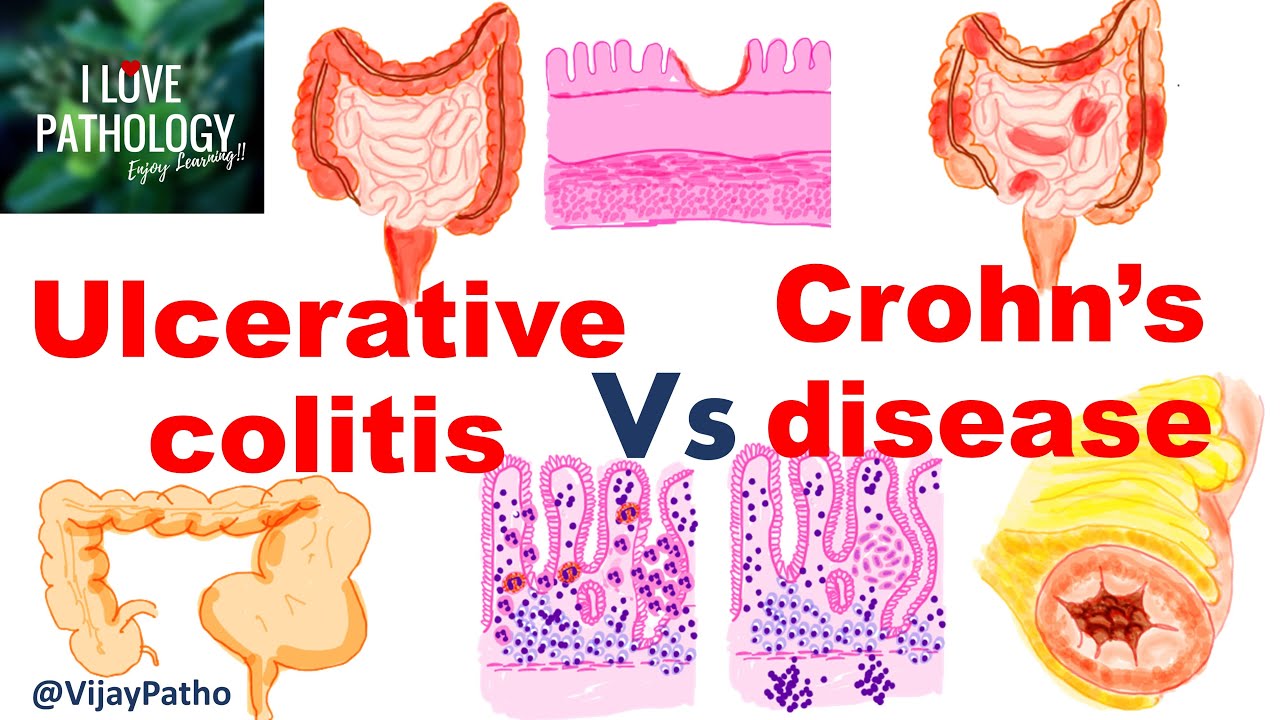 Ulcerative colitis Vs Crohn's disease #inflammatoryboweldisease - YouTube - Verschillen Ziekte Van Crohn En Colitis Ulcerosa