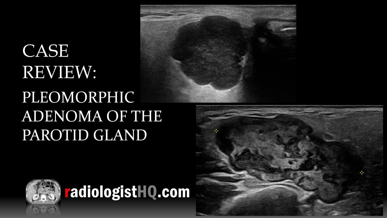 Ultrasound of Pleomorphic Adenoma of the Parotid Gland - YouTube - Tubulair Adenoom Met Laaggradige Dysplasie