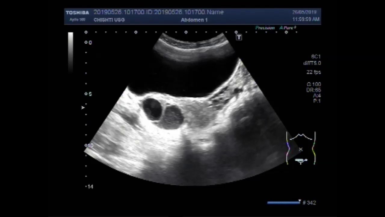 Ultrasound Video showing difference between the simple and hemorrhagic - Eierstok Niet Zichtbaar Op Inwendige Echo