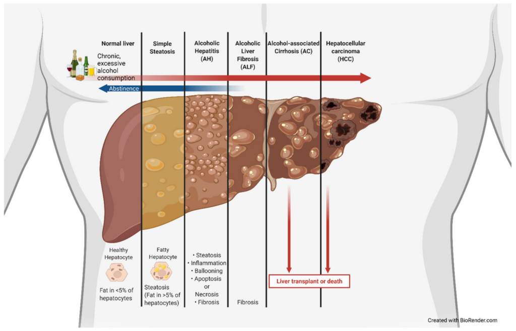 Understanding Alcohol-related Liver Disease - Ask The Nurse Expert - Pijn In Lever Na Alcohol