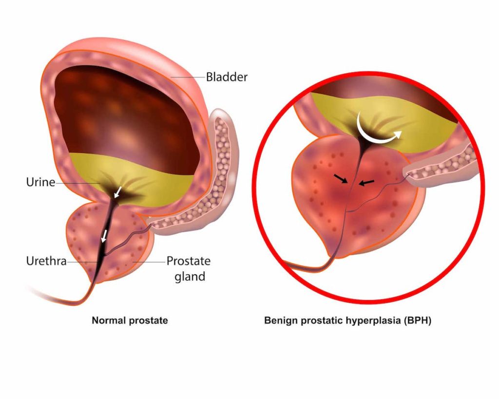 Understanding and Managing Benign Prostatic Hyperplasia - Wat Is De Functie Van Prostaat