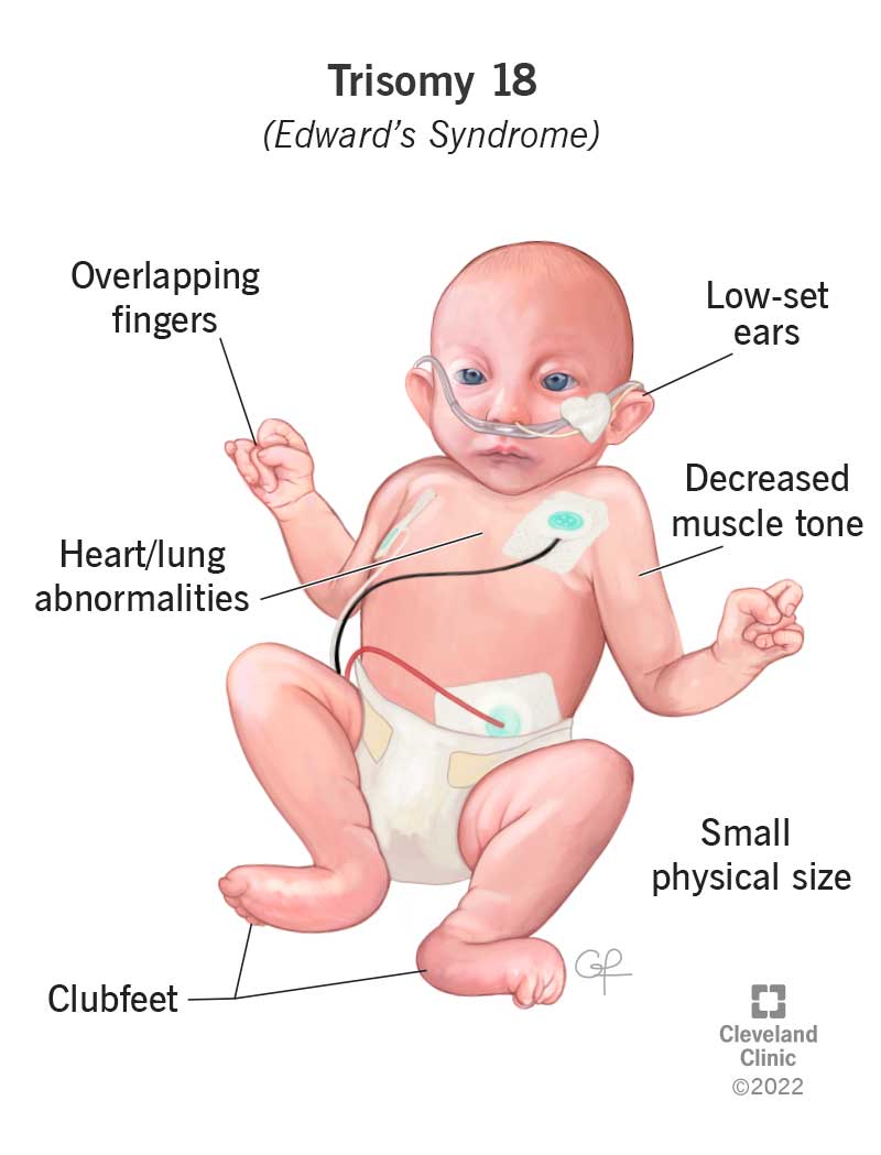 Understanding Edwards' Syndrome: Causes, Symptoms, And Treatment - Ask - Syndrome De Cornelia De Lange
