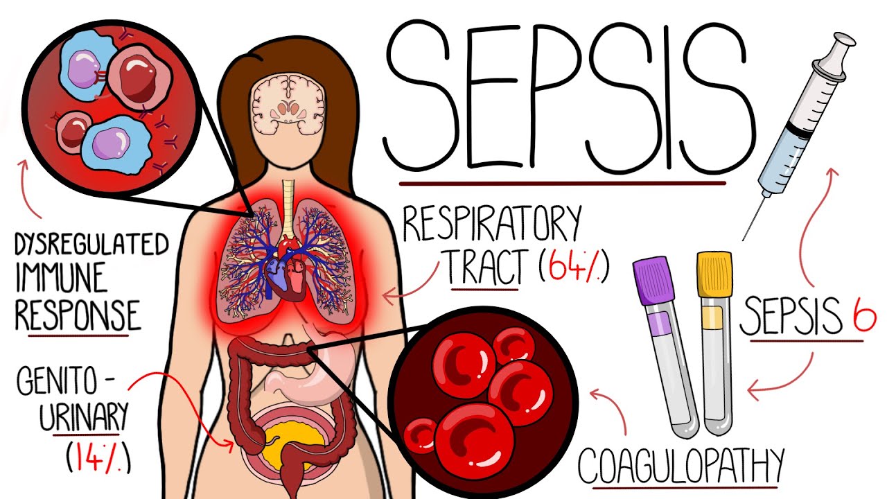 Wat Is Sepsis Voor Een Ziekte