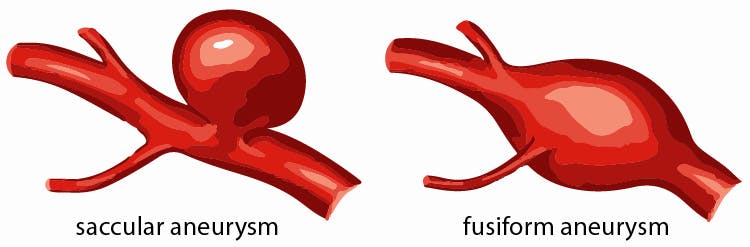 Understanding The Differences Between Stroke And Aneurysm - Thailand - Aneurysma In Het Hoofd Symptomen