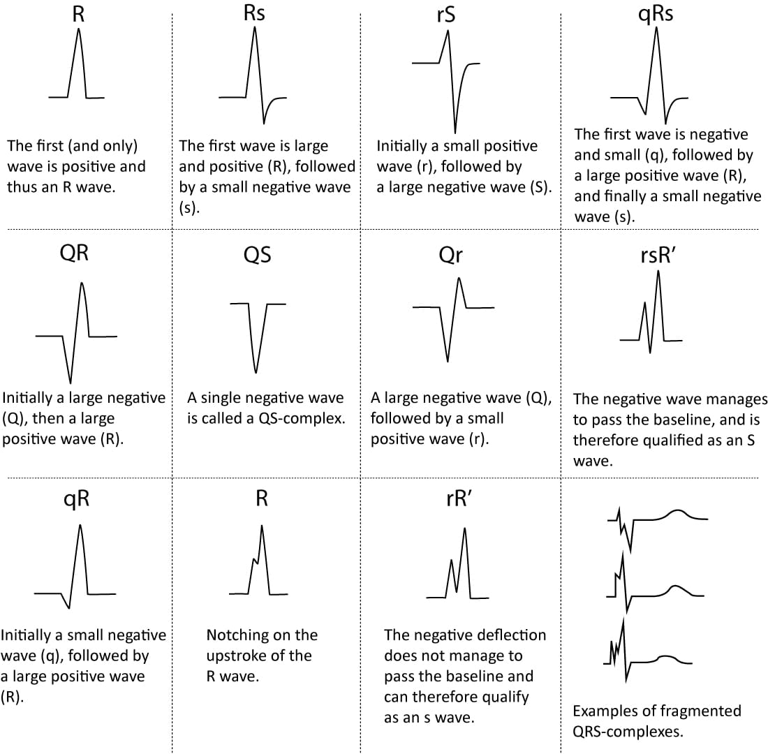 Negatieve T Top Ecg Betekenis