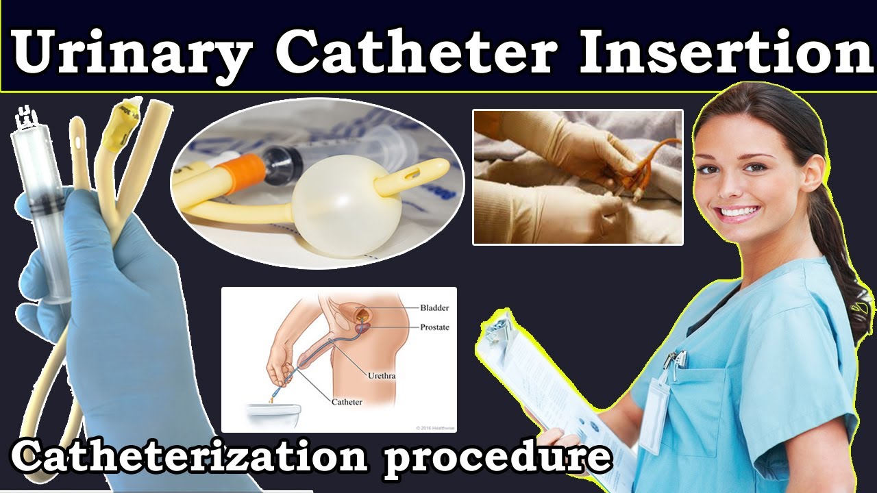 Wat Is Een Couvelaire Catheter
