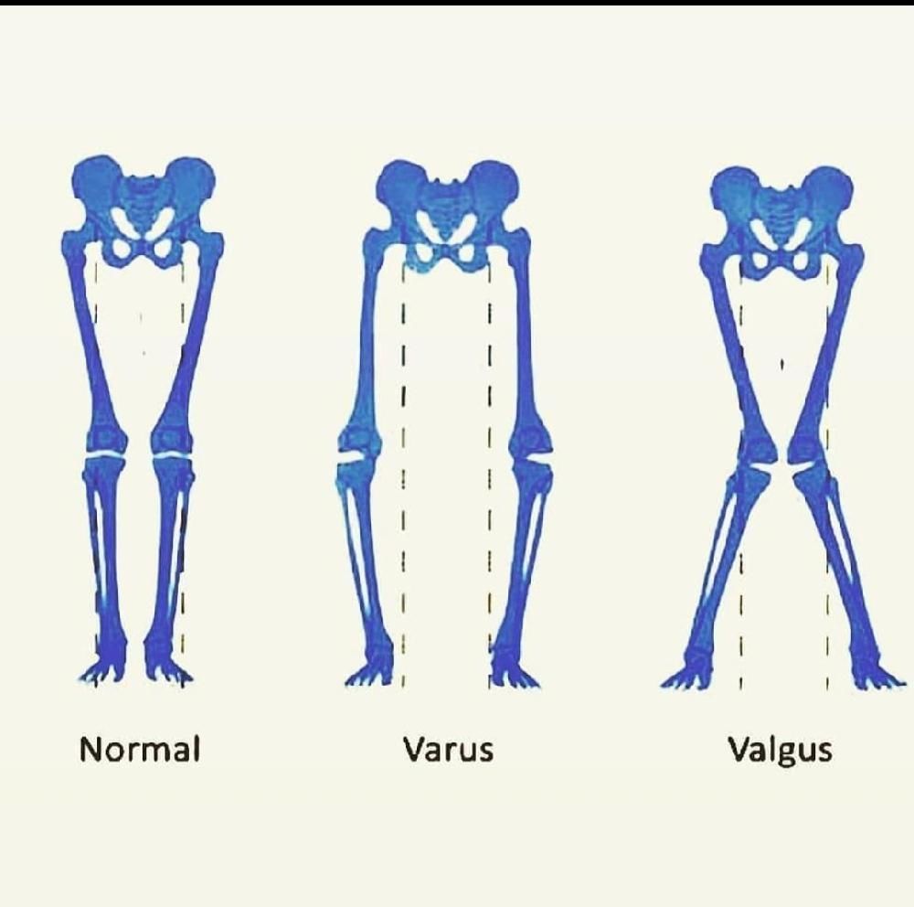 Valgus En Varus Stress Test