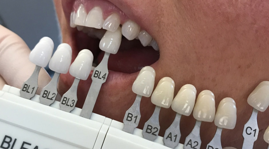 Veneers Bonding: Cosmetic Porcelain, Composite Custom Fit , 48% OFF - Kleur Tanden A1 Of B1