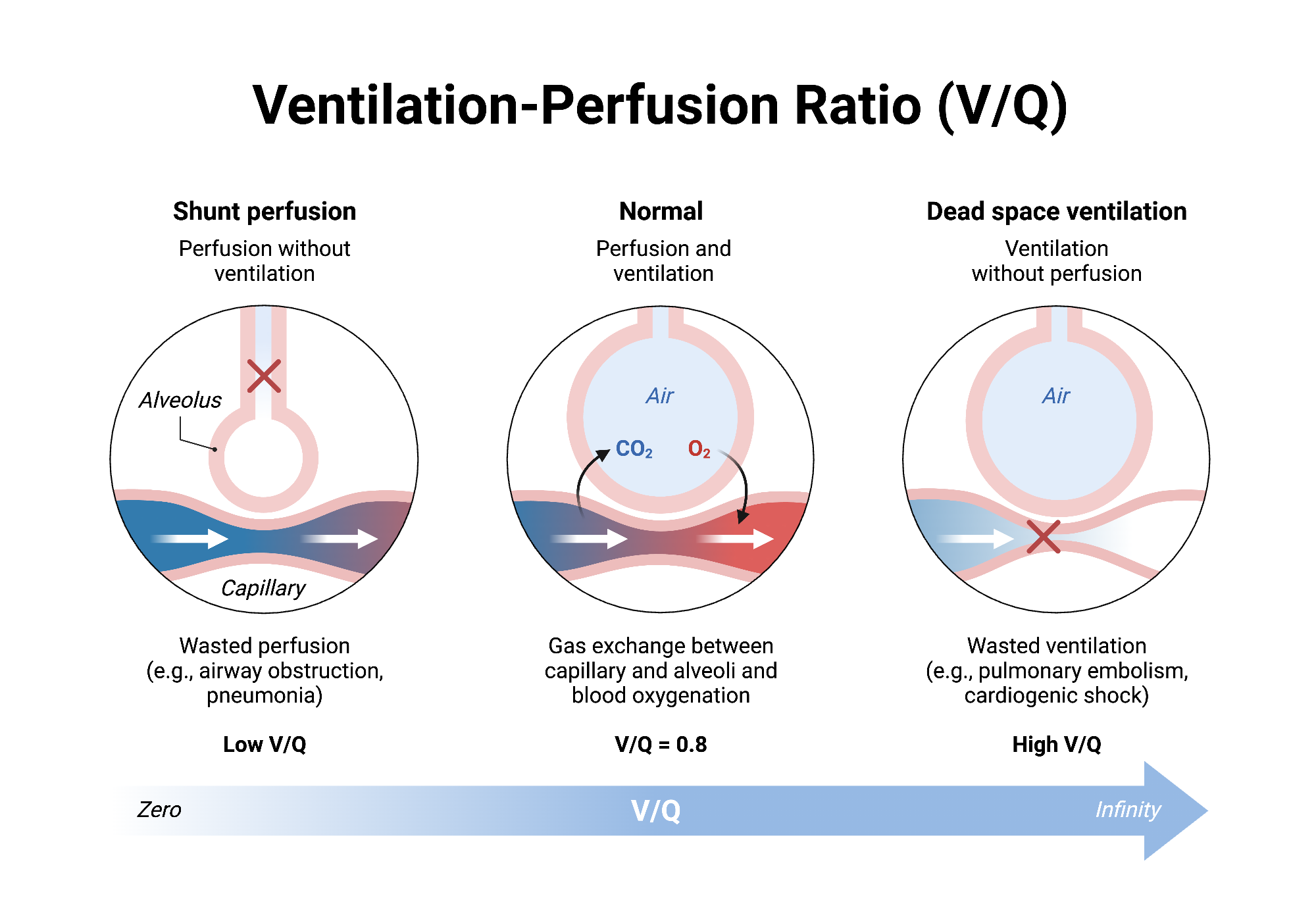 Ventilation-Perfusion Ratio (V/Q) | BioRender Science Templates - Dode Ruimte Ventilatie En Shunting