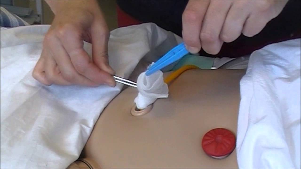 Verbandzorg Suprapubische sonde - YouTube - Wat Is Een Suprapubische Katheter