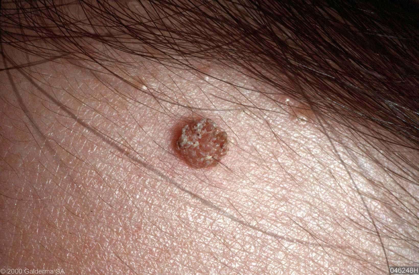 verruca plana - pictures, photos - Hoe Ziet Huidkanker Eruit In Je Gezicht