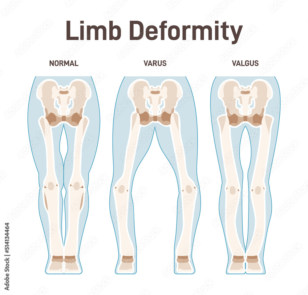 Vetor de Limb anatomy scheme. Valgus and varus leg deformities. Diagram - Valgus En Varus Stress Test