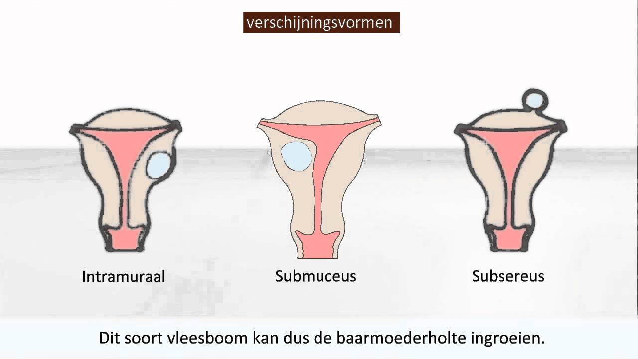 Vleesboom - Klachten en verwijderen - YouTube - Opgezette Buik Door Poliep Baarmoeder