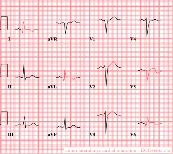 Voorwandinfarct - ECGpedia - Acuut Myocardinfarct Zonder St Elevatie