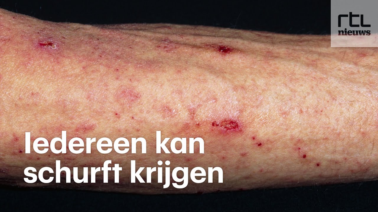 Hoe Lang Blijft Koolmonoxide In Je Bloed