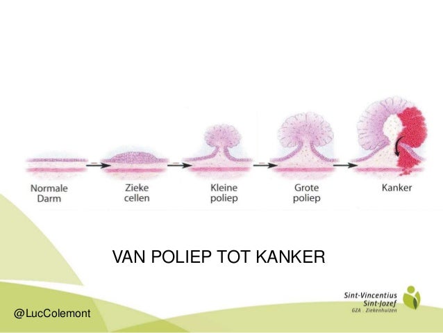 "Vroegtijdig opsporen van darmkanker" - Poliep Goedaardig Gezwel In Keel