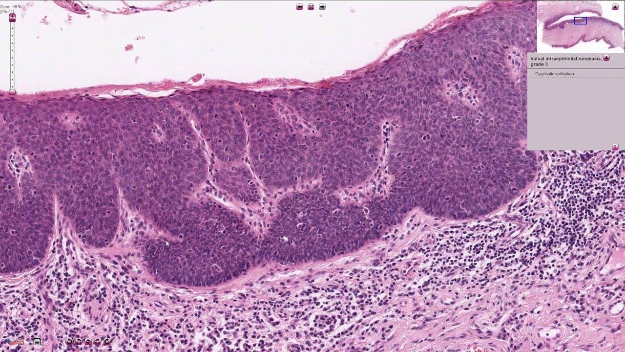 Vulvar Intraepithelial Neoplasia (U-VIN) Histopathology - YouTube - Bethesda Negatief Voor Intra Epitheliale Neoplasie
