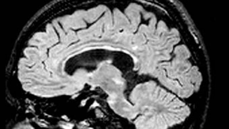 Wanneer Contrastvloeistof Bij Mri-scan Hersenen