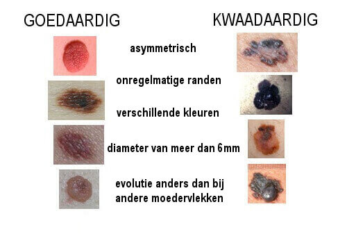 Waarschuwingstekens van huidkanker - Gezonder Leven - Verschil Goedaardige En Kwaadaardige Tumor