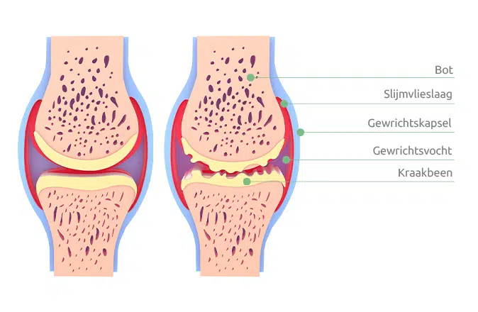 Wat is artrose? - Oorzaken en Symptomen - Otolift - Wat Is Het Verschil Tussen Artrose En Coxartrose