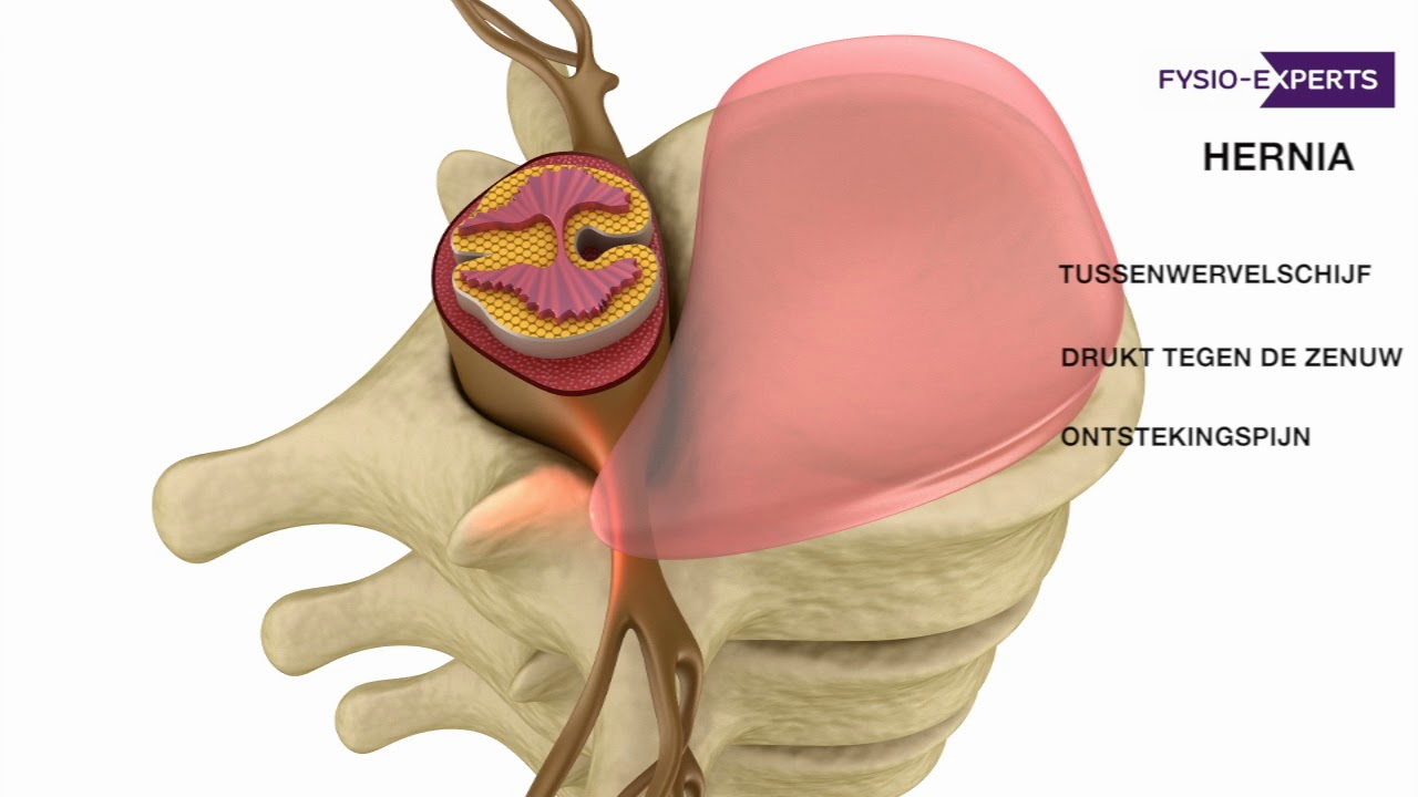 Wat is een hernia in de lage rug (HNP)? - YouTube - Wat Te Doen Bij Hernia