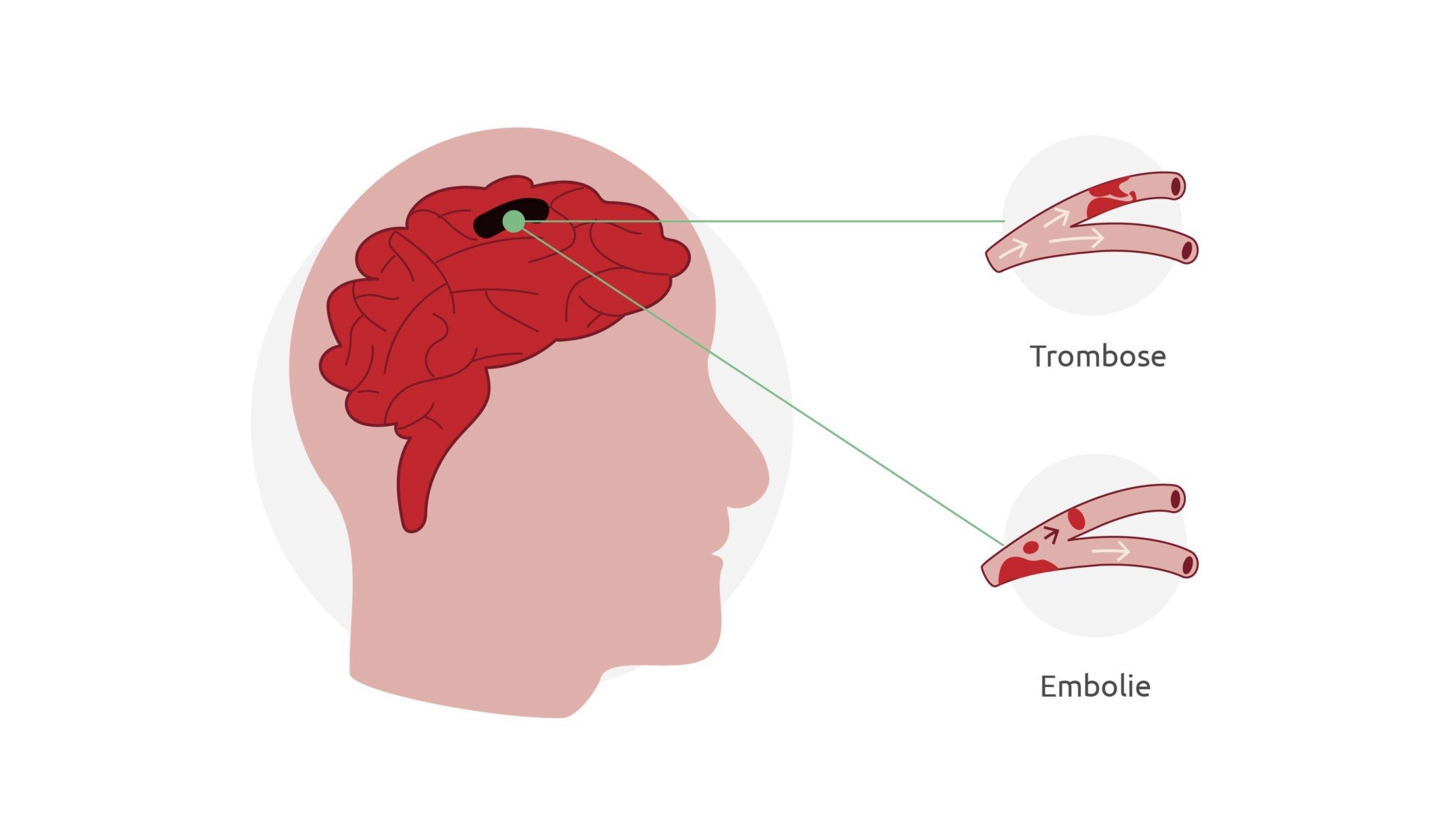 Wat is een TIA en wat zijn de symptomen? - Otolift - Wat Is Het Verschil Tussen Een Tia En Een Herseninfarct