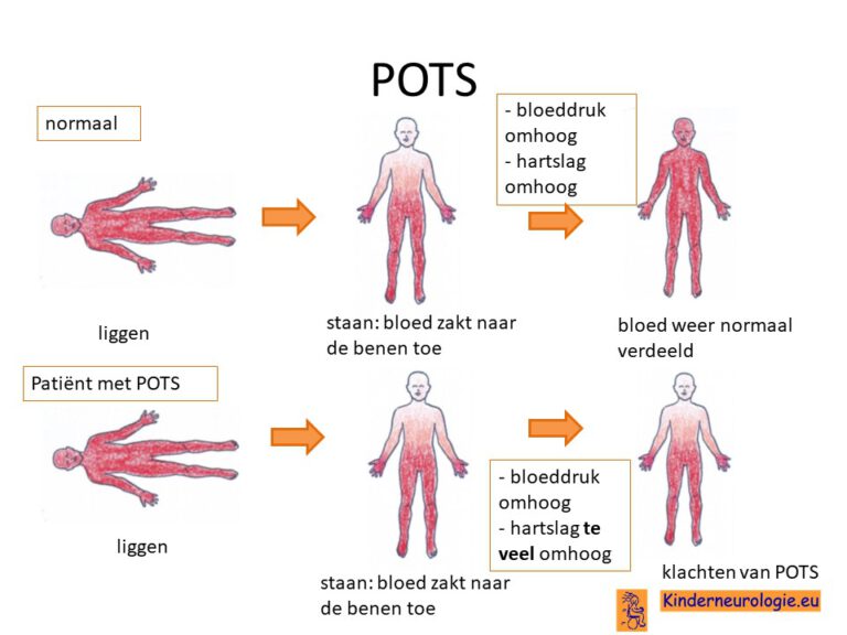 Wat Is Pots Voor Ziekte