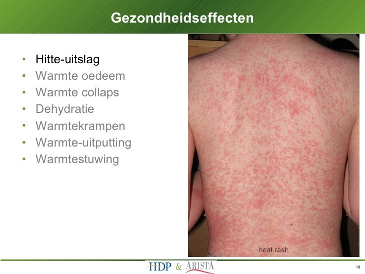 Wat Te Doen Aan Warmte Uitslag