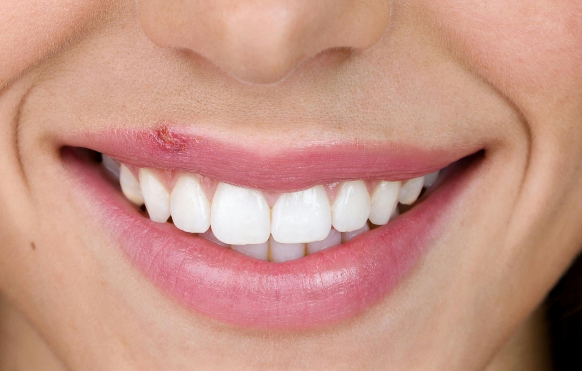 What Are Sore Lips A Sign Of | Lipstutorial.org - Hoe Ziet Beginnende Koortslip Eruit