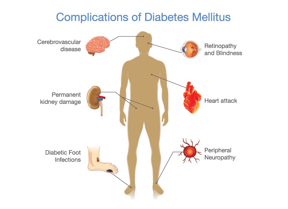 What Cause PCOS And Relation With Diabetes ? Risk Of PCOS - Complicaties Diabetes Type 2 Korte Termijn
