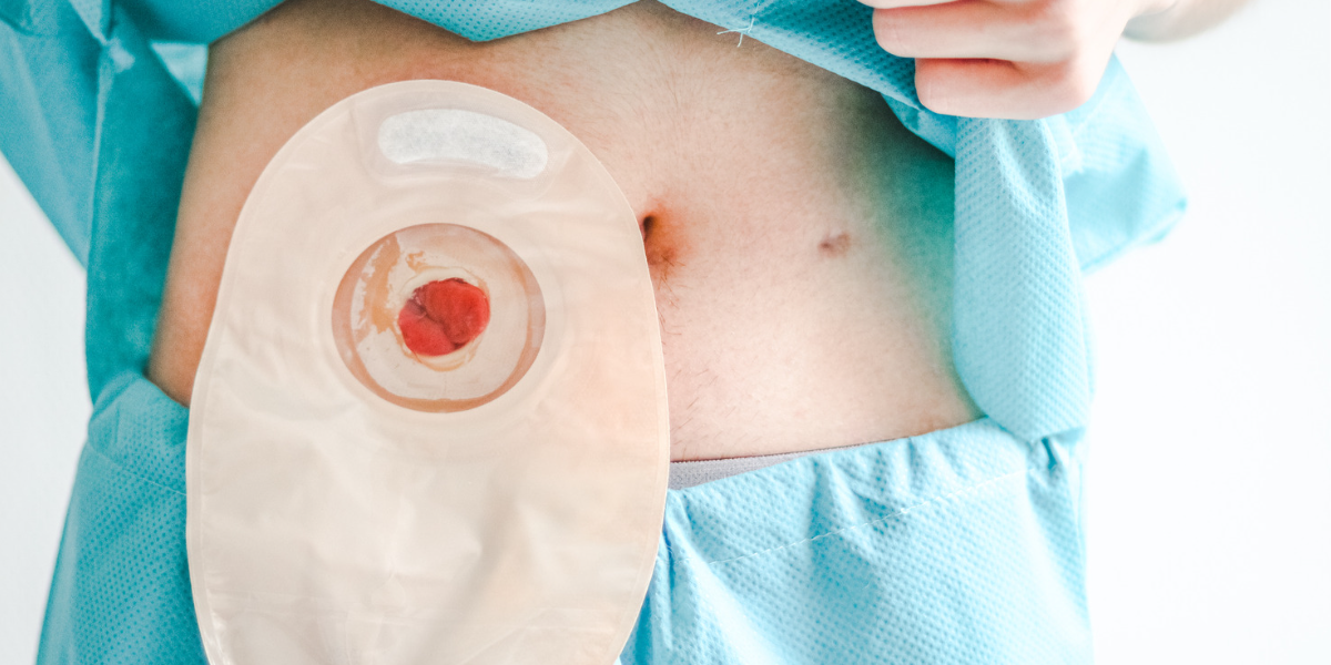 What Is A Stoma: Is It Reversible? | Cha Surgery - Stoma Toch Ontlasting Via Anus