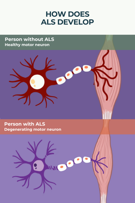What is Amyotrophic Lateral Sclerosis (ALS)? | ALS News Today - Als G'in Nood Gezeten Tekst