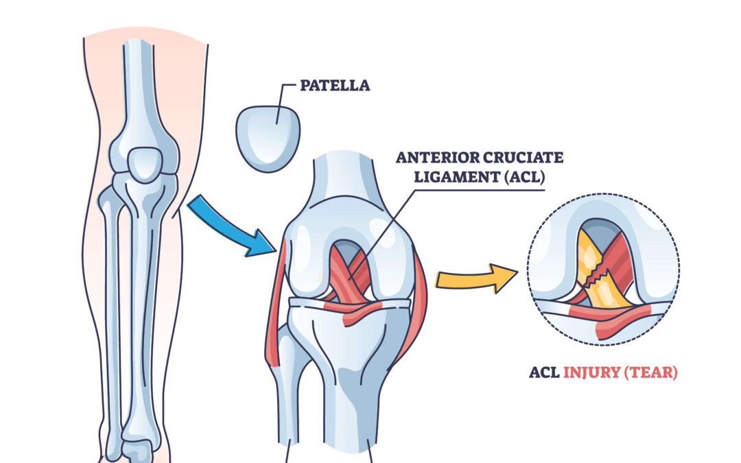 What is an ACL Injury? | BCOS - Wat Is Een Acl Blessure