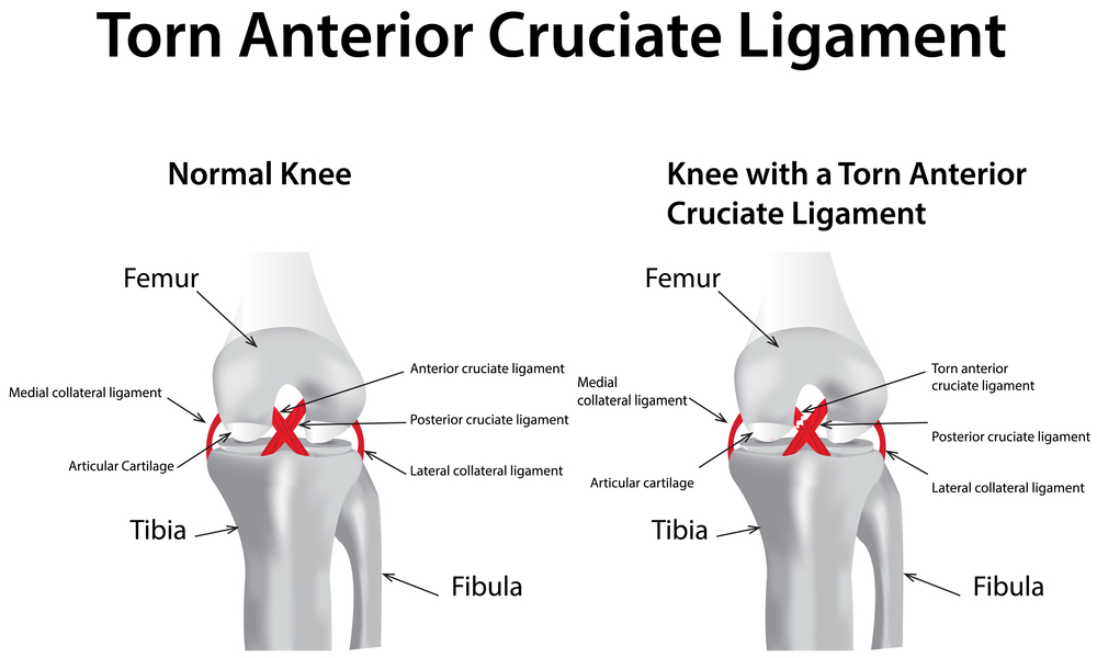 Wat Is Een Acl Blessure
