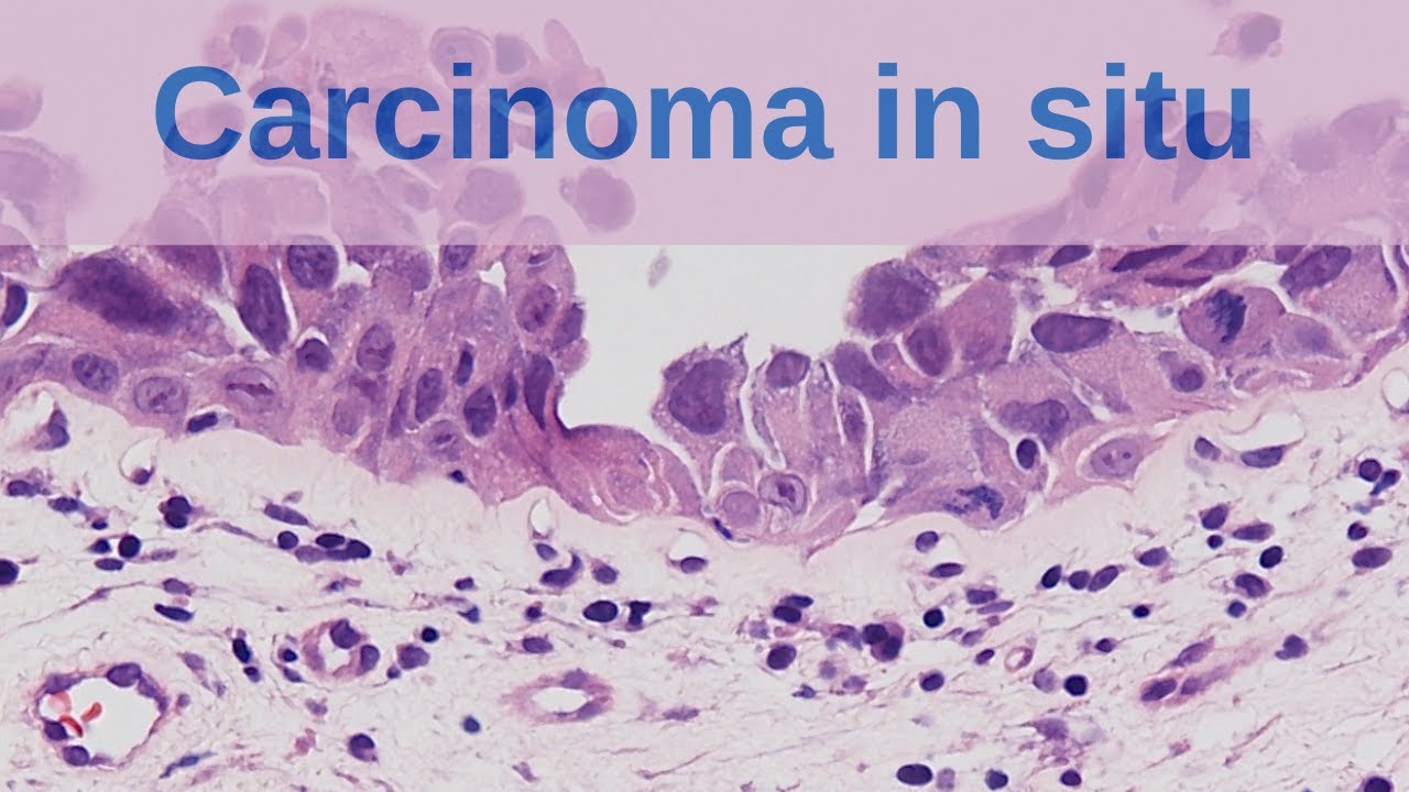 What is Carcinoma in situ? - Pathology mini tutorial - YouTube - Invasief Carcinoom Nst Bloom Richardson Graad 2