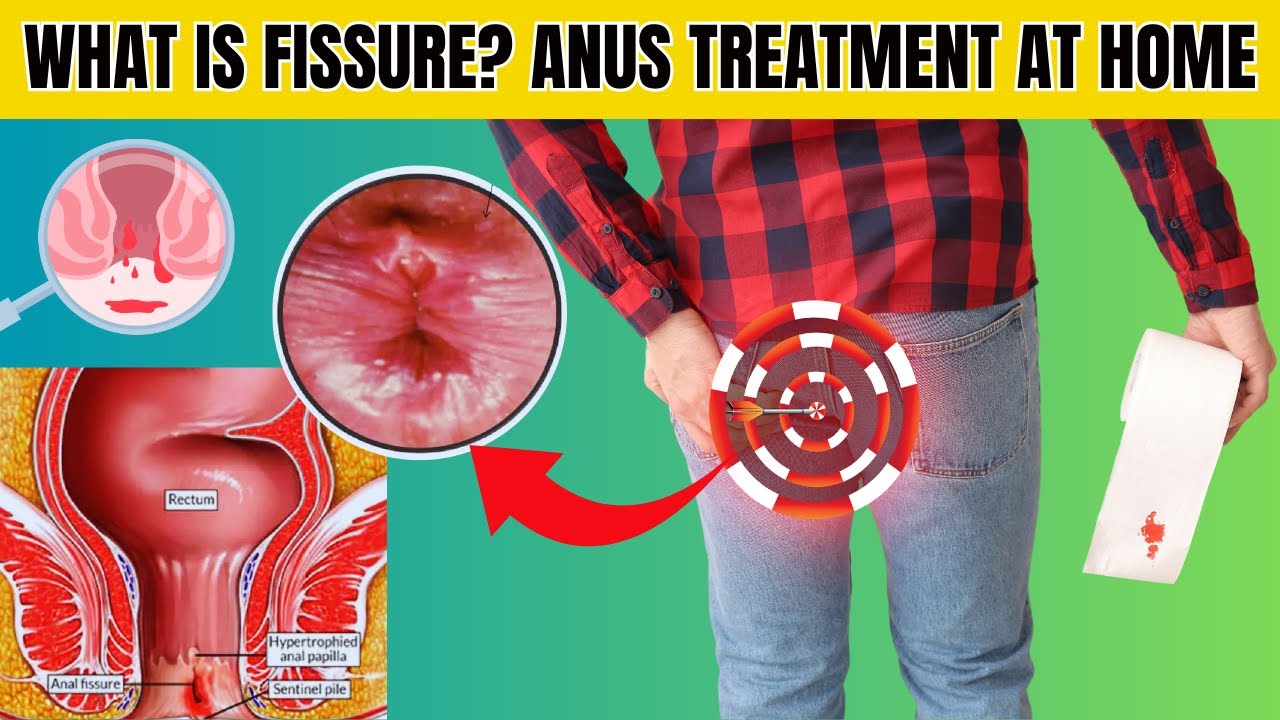 What Is Fissure Sharp Pain In Anus Treatment At Home - YouTube - Pijn In Anus Bij Zitten