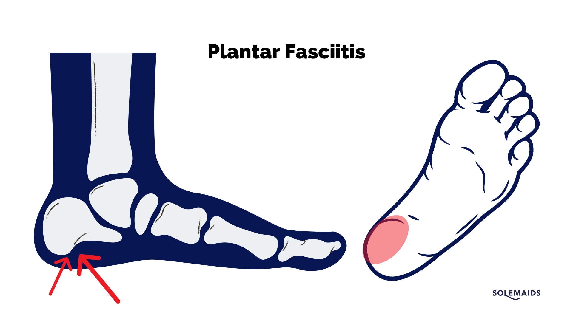 What is Plantar heel pain? Learn everything about it here! - Heel Getal Delen Door Breuk