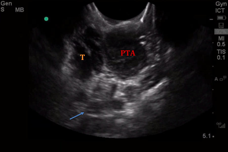 What is that Hot Potato Voice? POCUS for the PTA — BROWN EMERGENCY MEDICINE - Wat Is Een Pta Toets
