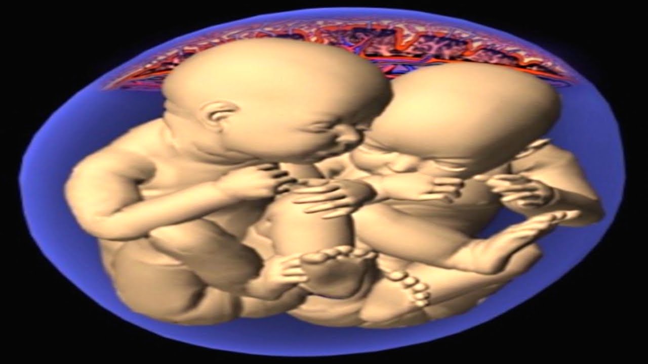 What is Twin to Twin Transfusion Syndrome? TTTS Explained Animation - Overlevingskans Tweeling Met Tts Syndroom