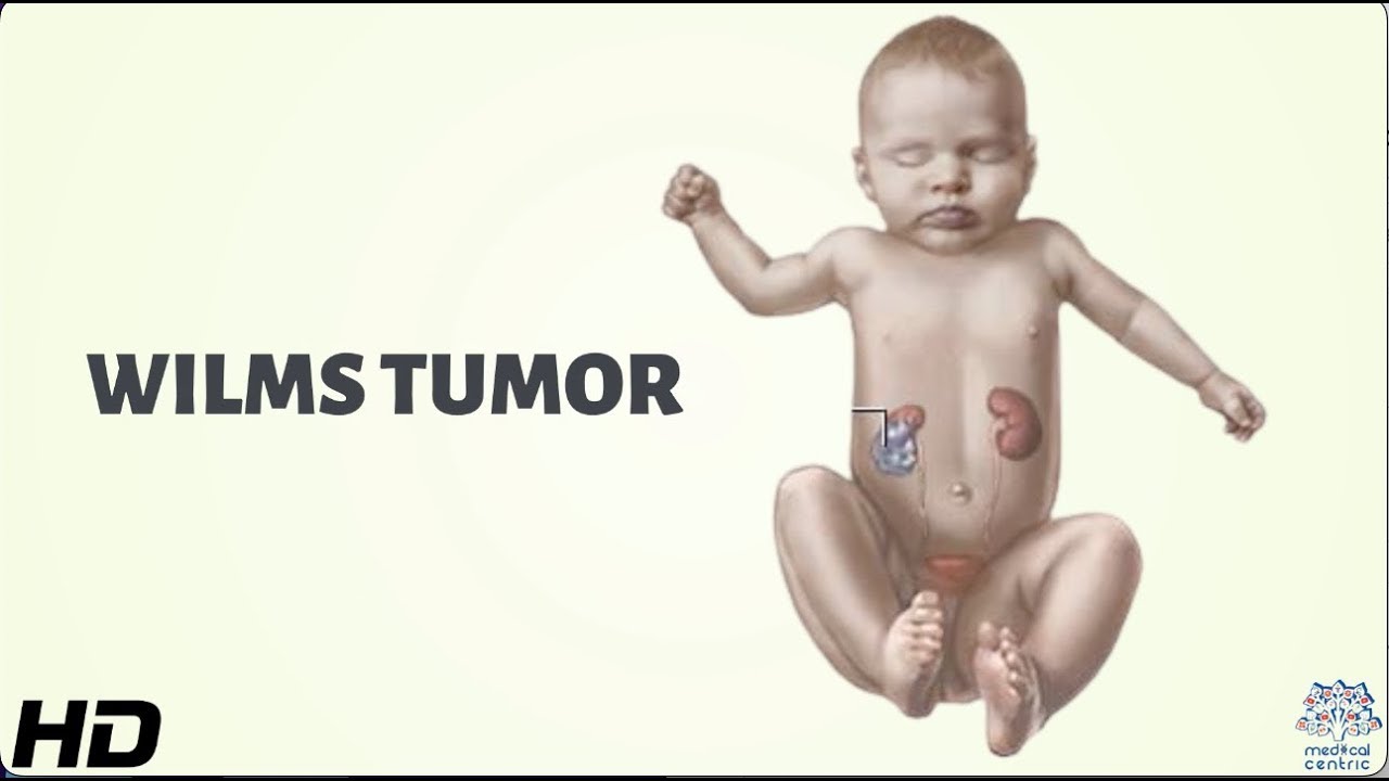 Wilms' Tumor: Everything You Need To Know - YouTube - Is Een Tumor Hard Of Zacht