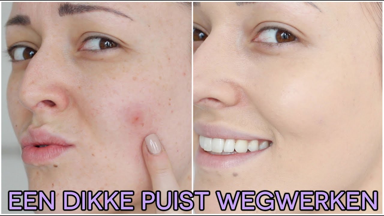 Wondje Tattoos - Puntbloedinkjes Rode Puntjes Op Huid