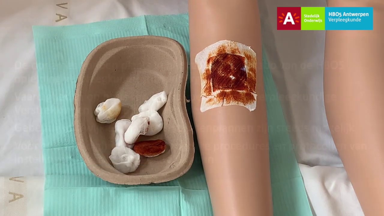 Wondzorg: Kritisch gekoloniseerde open wonde - YouTube - Wat Is Een Open Wond