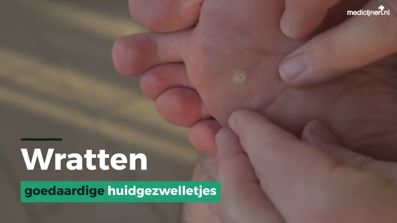 Wratten - YouTube - Gaan Genitiale Wratten Vanzelf Weg