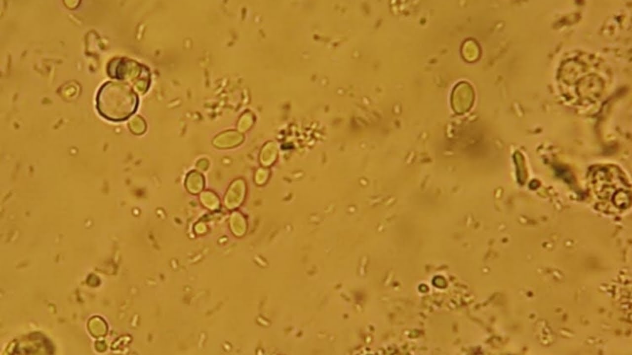 Teveel Eiwit In Urine Oorzaak